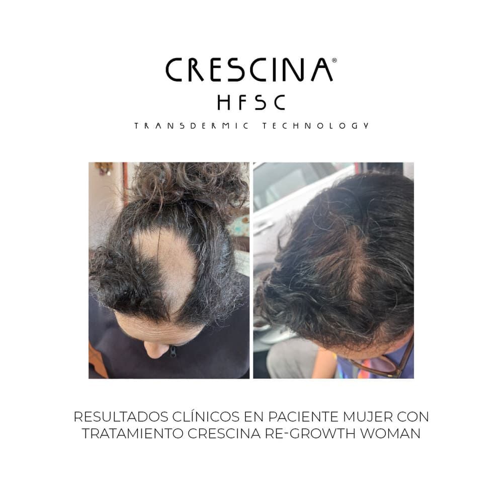 Crescina-Re-Growth-500-Woman-imagen-5